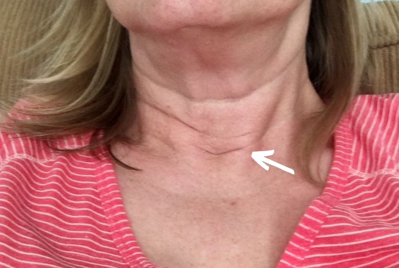 Post-surgical scar after parathyroidectomy