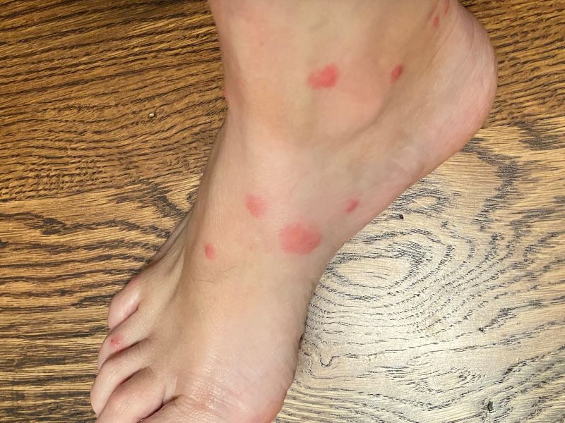 fire ant bites on foot